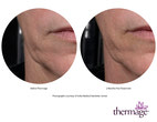 Results using the new Total Tip from Thermage﻿!